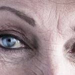 xeomin crows feet ageing eyes