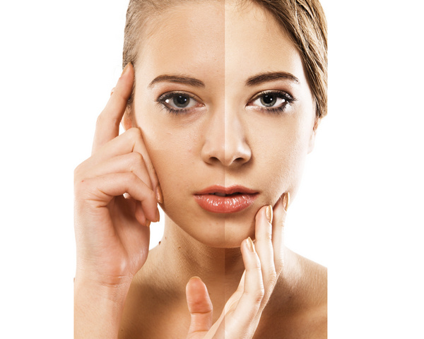 dysport Sun damages skin, skin spots, treatments