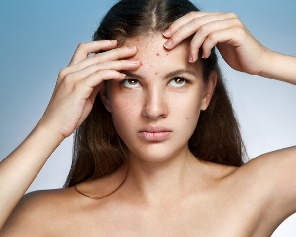 acne and what you eat, acne treatments, acne and diet, acne and nutrtion
