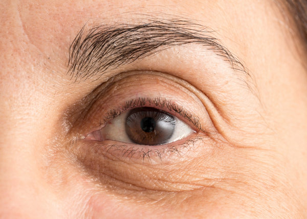 under-eye-bags-shadows-eyelids-surgery