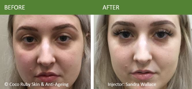 under-eye-bags-shadows-filler-injections
