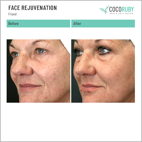 Nasolabial Folds Treatment