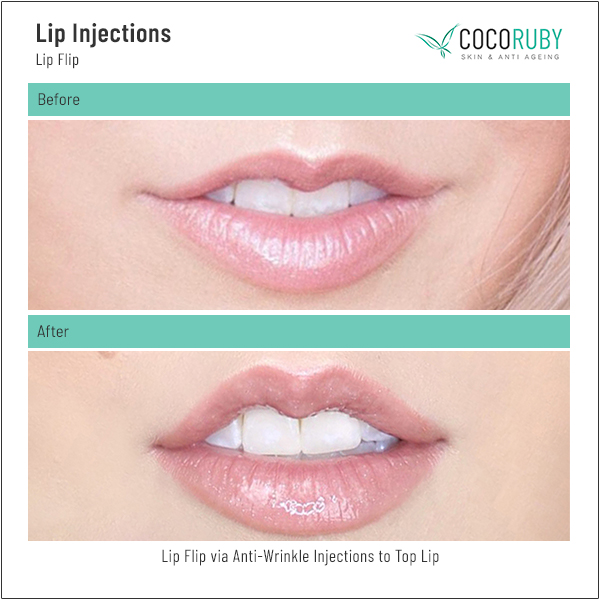 lip-injections-before-and-after-40