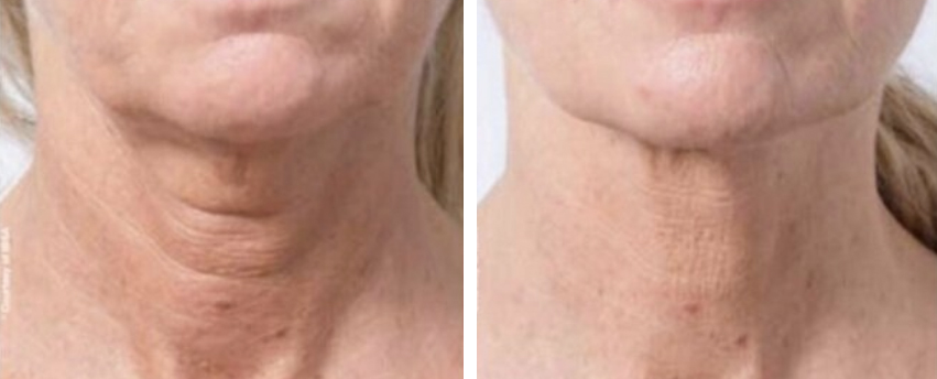 profhilo before and after